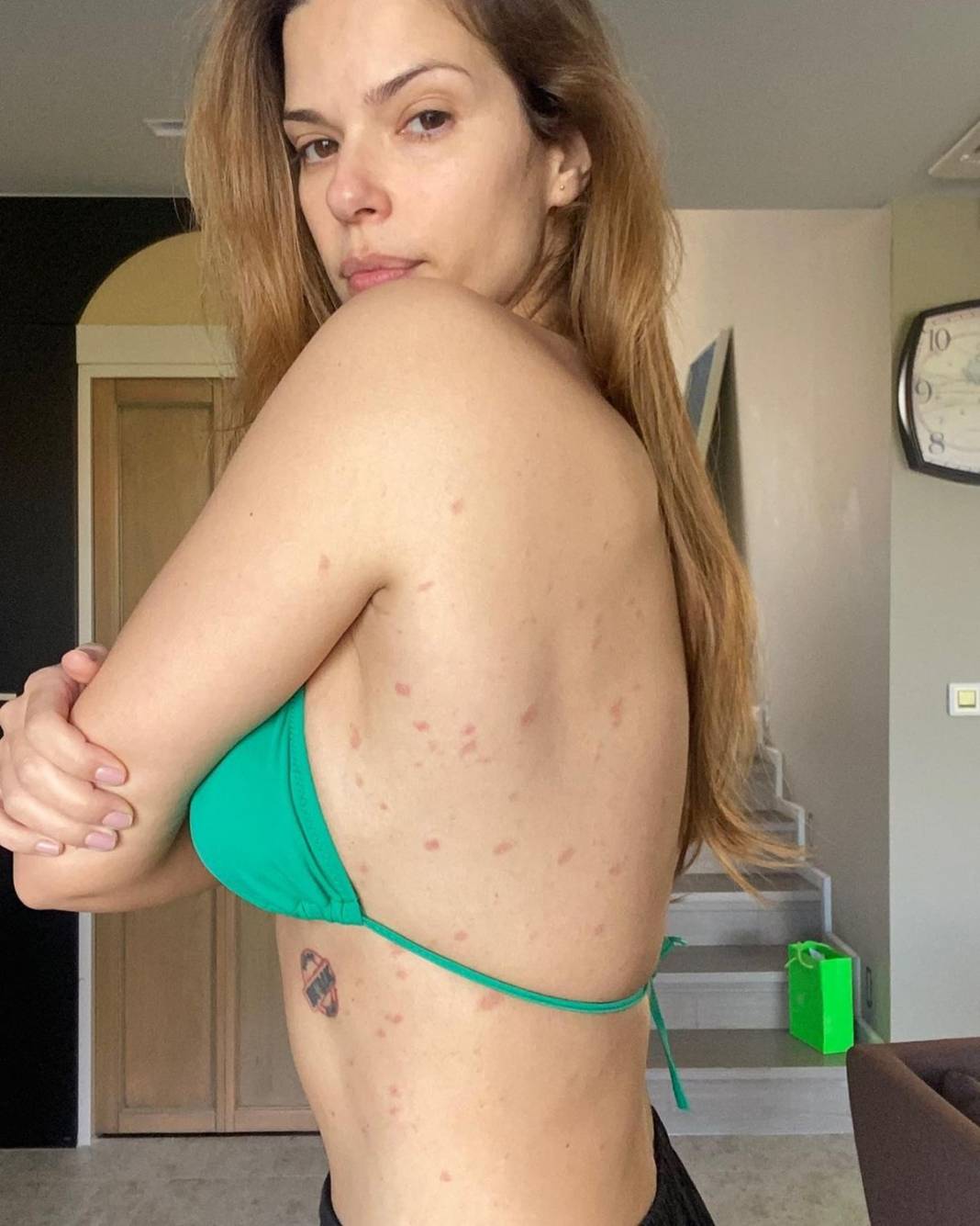 Vücudunu göstererek yakalandığı hastalığı paylaştı! Takipçileri kahroldu... 7